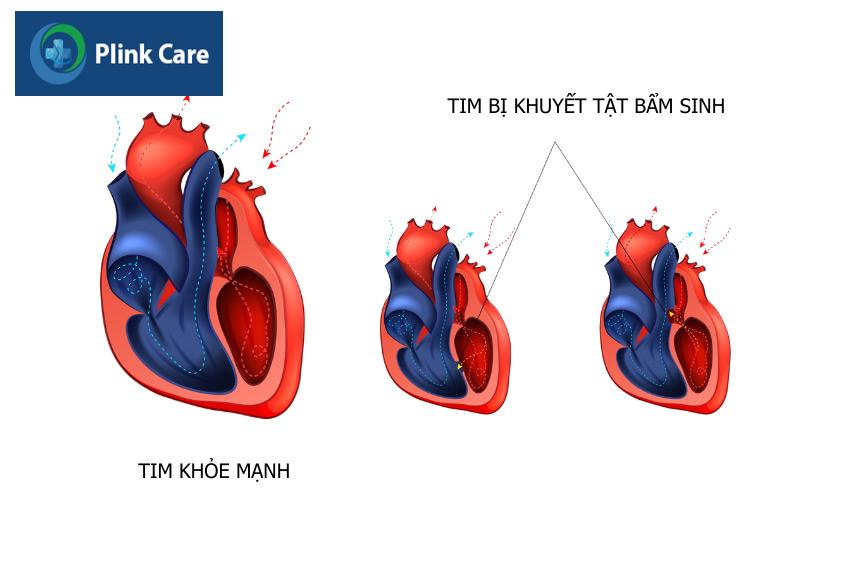 Hình ảnh tim khỏe mạnh (bên phải) và tim bị dị tật bẩm sinh (bên trái)