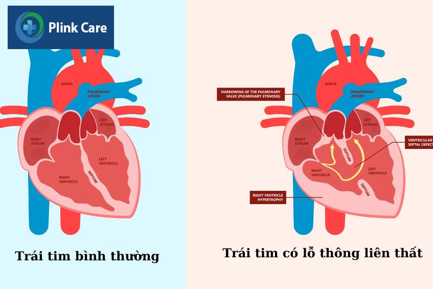 Hình ảnh trái tim bình thường và trái tim có lỗ thông liên thất