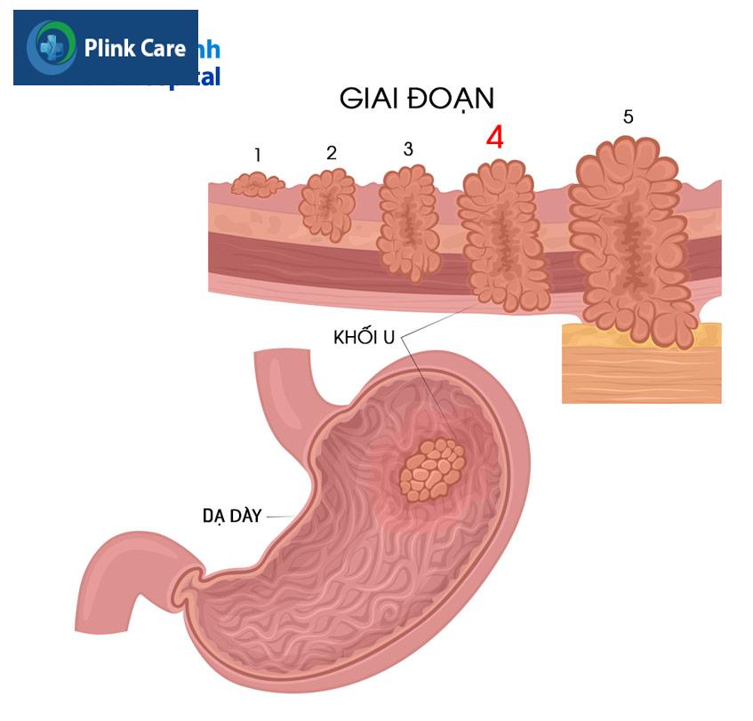 khối u ở dạ dày ở các giai đoạn