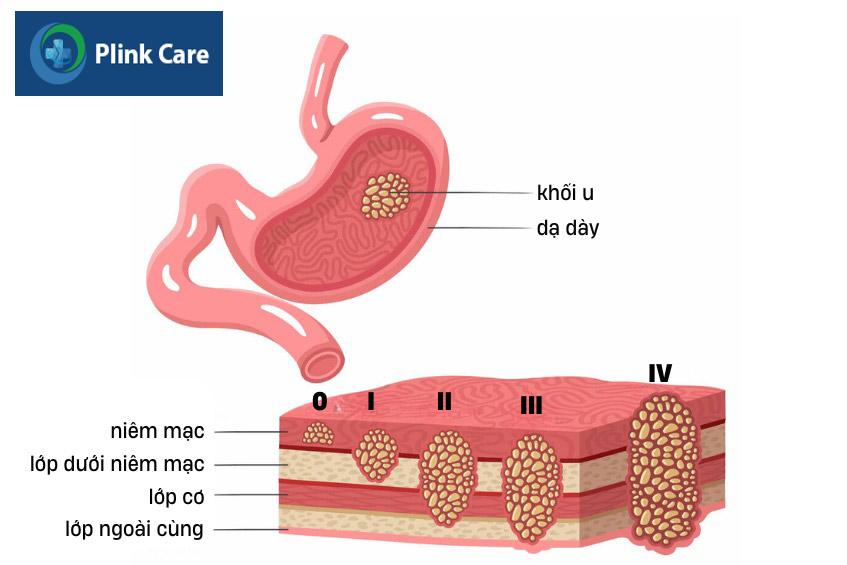 khối u ung thư dạ dày qua từng giai đoạn