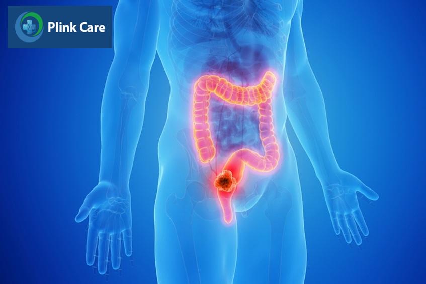 lạc quan khi điều trị ung thư trực tràng