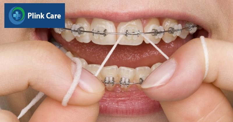 Bọc răng sứ, niềng răng làm tăng nguy cơ mắc hôi miệng