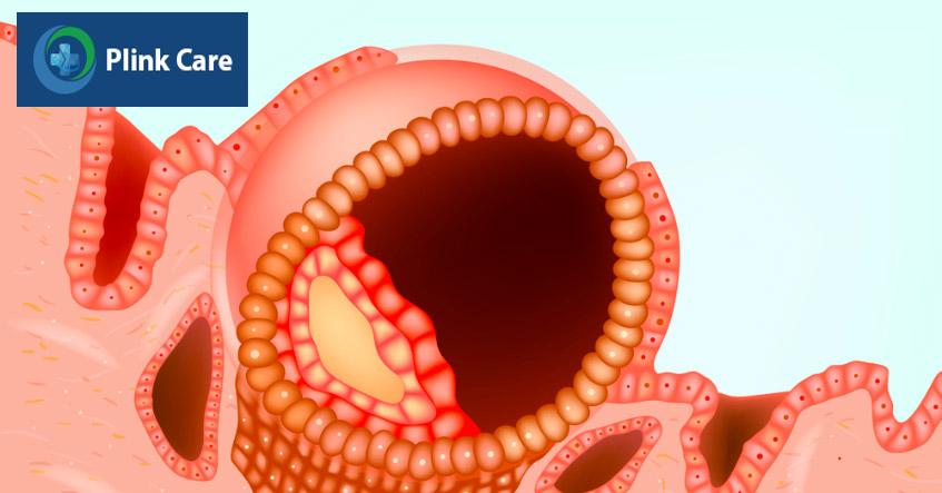Màng zona của phôi ngày 6 mỏng dần tại một vị trí và bị phá vỡ, phôi sẽ thoát qua lỗ này để đi vào buồng tử cung, chuẩn bị làm tổ