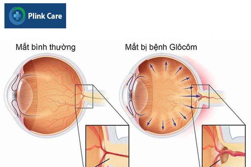 mắt thường và mắt bị glocom
