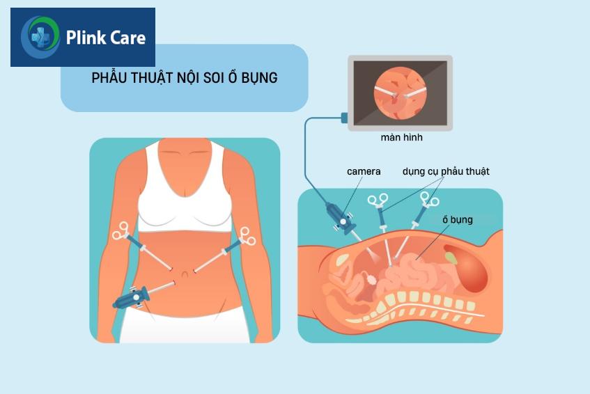 minh họa phẫu thuật nội soi ổ bụng