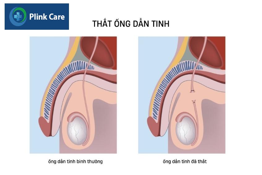 minh họa thắt ống dẫn tinh