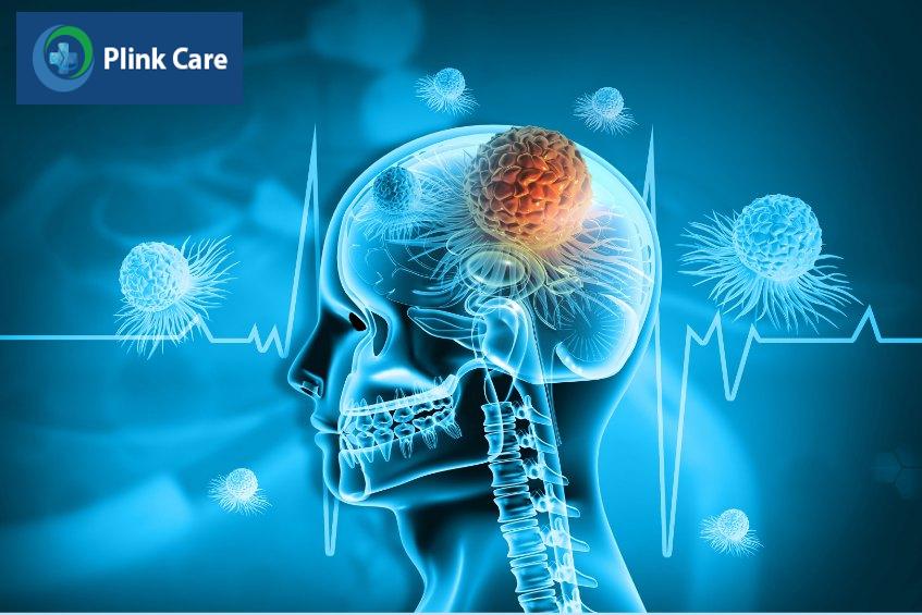 mô phỏng khối ung thư não giai đoạn đầu