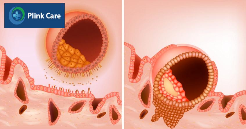 Nếu chuyển đúng vào thời gian mở cửa sổ làm tổ, khả năng cao phôi bám niêm mạc thành công