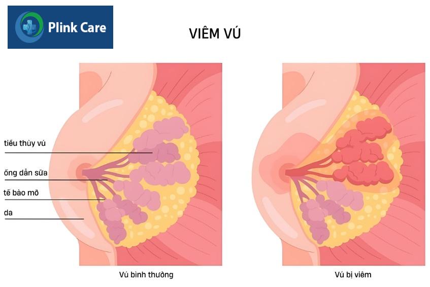 ngực ấn vào bị đau