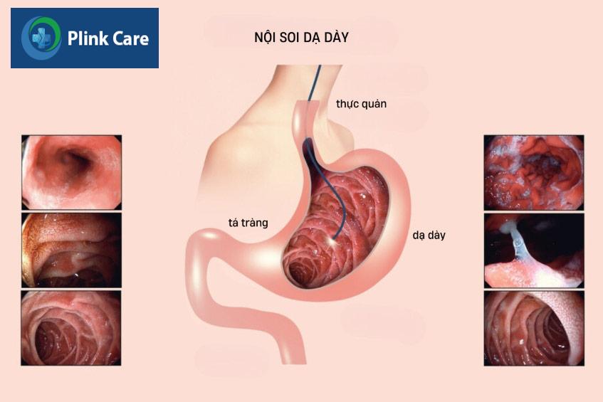 nội soi dạ dày để tầm soát ung thư