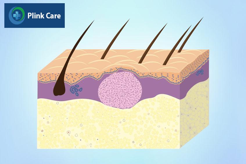 nốt u sợi bì dermatofibroma dưới da