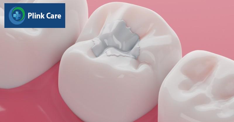 Cách điều trị bệnh sâu răng cho từng mức độ