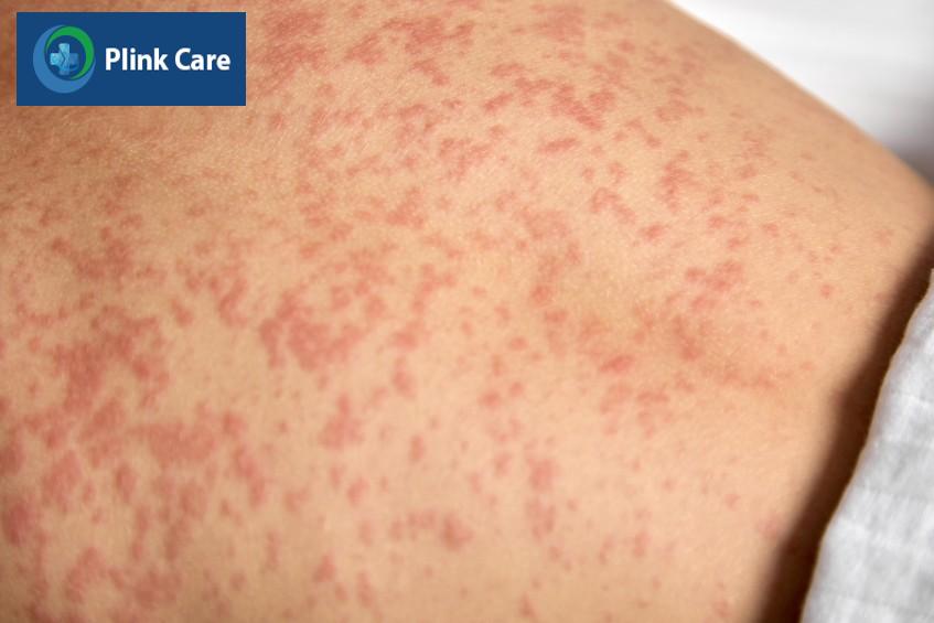 phát ban sởi có các đốm đỏ loang lỗ hơi nổi lên nhưng ít gây ngứa