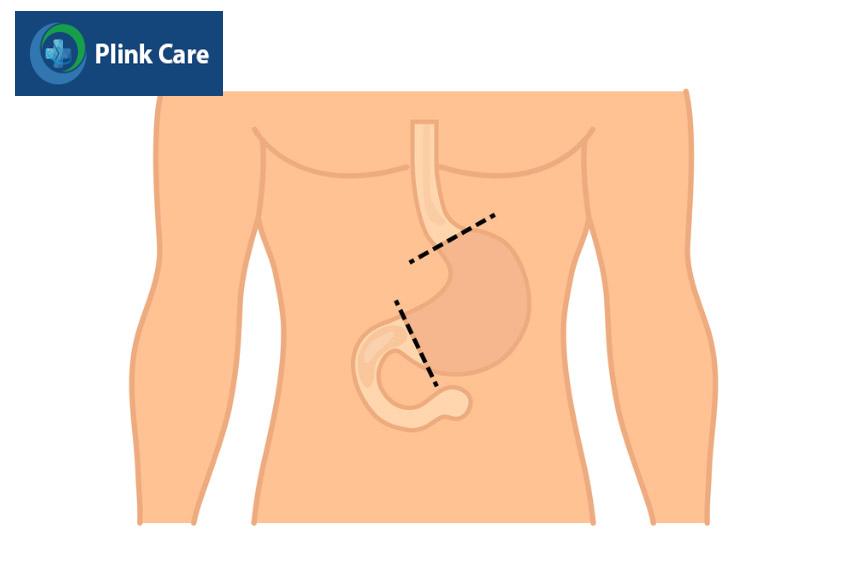 phẫu thuật điều trị triệt căn ung thư dạ dày