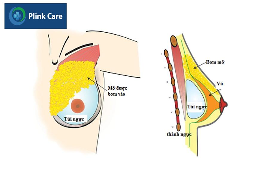 phẫu thuật nâng ngực kết hợp