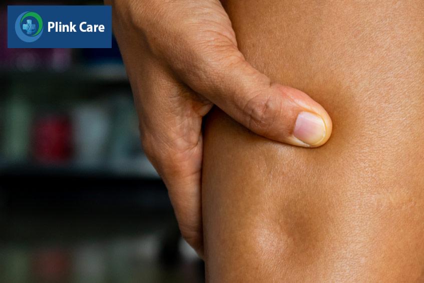 Phù trong suy tim thường là dạng phù mềm, khi ấn vào sẽ lõm xuống