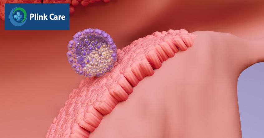 Sau khi được chuẩn bị thích hợp với progesterone, nội mạc tử cung đạt đến trạng thái sẵn sàng để tiếp nhận phôi đến làm tổ