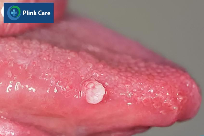 sùi mào gà có thể phát triển trên cả niêm mạc lưỡi
