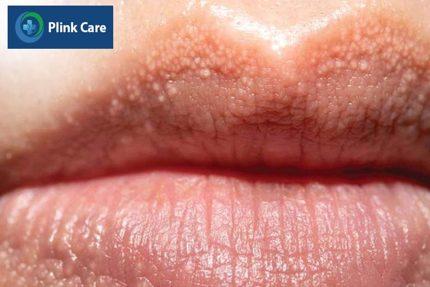 sùi mào gà ở môi thường dễ bị nhầm với hạt fordyce