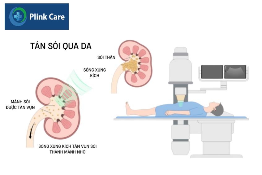 tán sỏi qua da bằng sóng xung kích