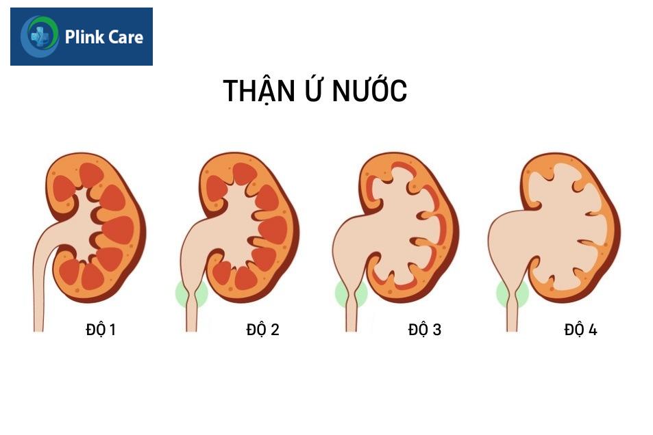 tình trạng thận ứ nước tiến triển ra sao