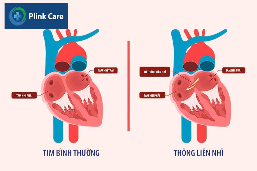 Hình ảnh tim bình thường và tim bị thông liên nhĩ ở trẻ