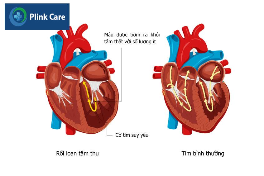 Hình ảnh minh họa trái tim bình thường (bên phải) và trái tim bị rối loạn tâm thu (bên trái)