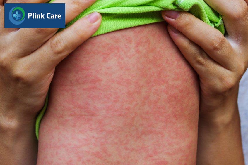 Trẻ bị sởi ở sốt cao và phát ban đỏ toàn thân khi bệnh