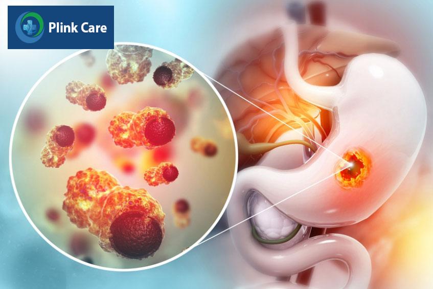triệu chứng đặc trưng của ung thư dạ dày là người bệnh sụt