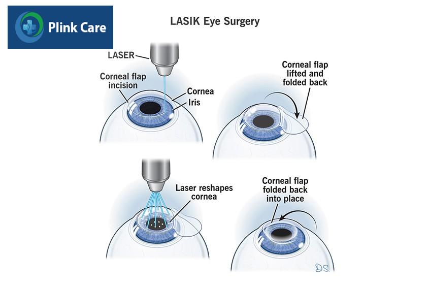 trong lasik bác sĩ sử dụng tia laser để định hình lại giác mạc