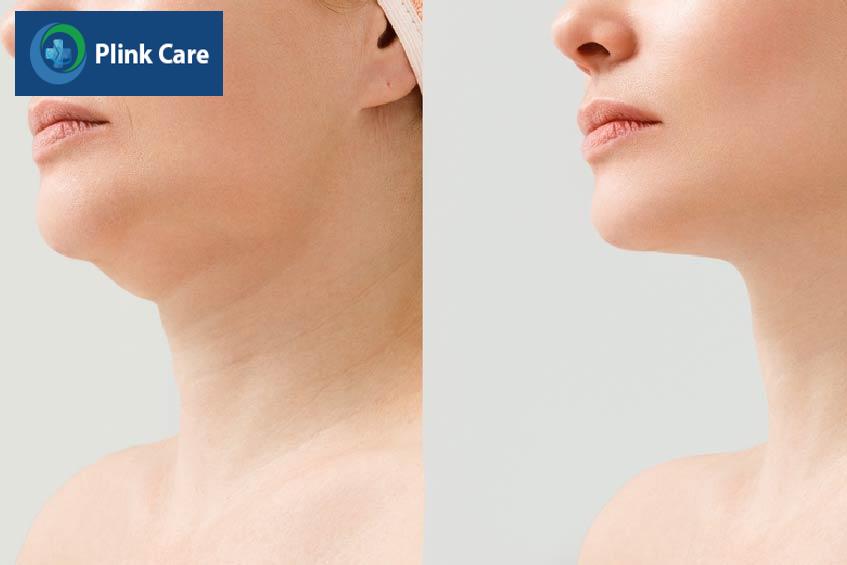 trước và sau điều trị u mỡ dưới cằm