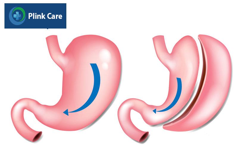 trước và sau phẫu thuật cắt dạ dày một phần