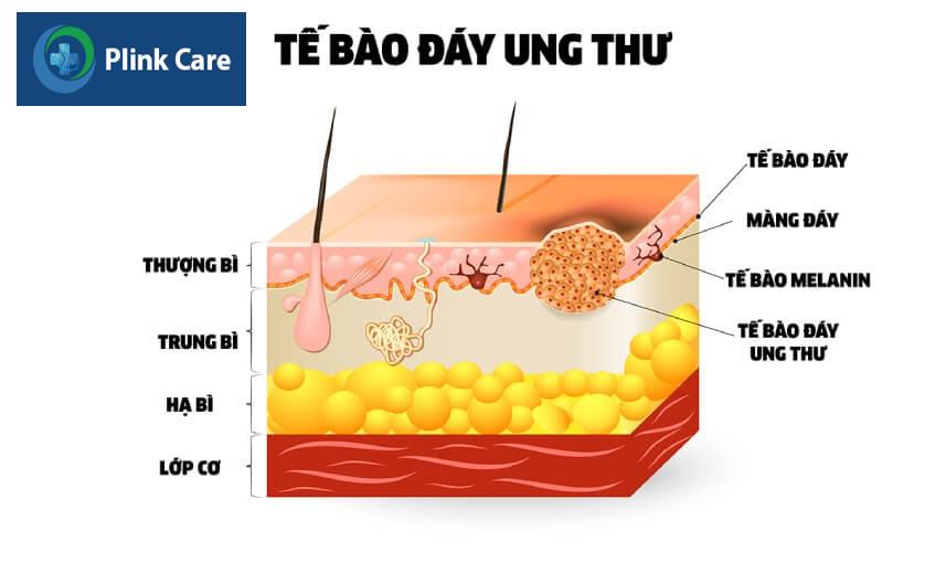 ung thư biểu mô mô tế bào đáy