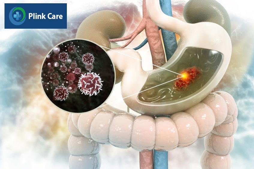 ung thư dạ dày giai đoạn 1 chưa xâm lấn qua lớp niêm mạc dạ dày
