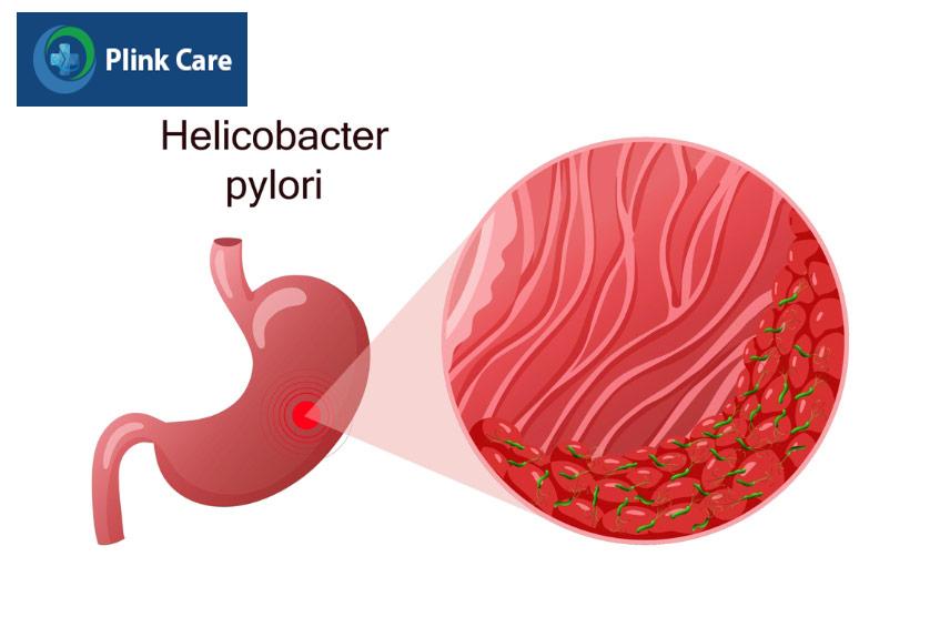 vi khuẩn helicobacter pylori