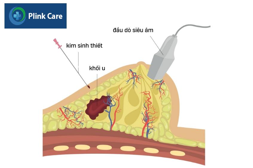 vú bị đau khi ấn vào