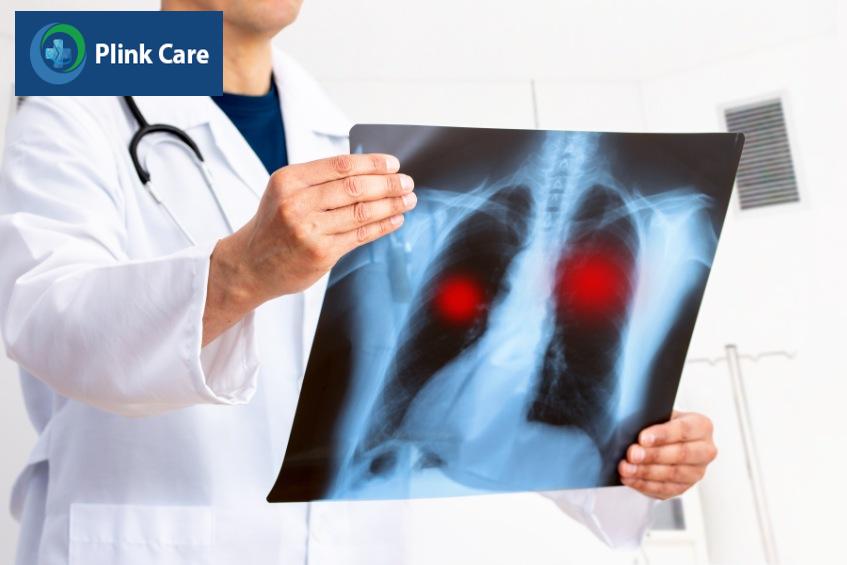 Xét nghiệm hình ảnh chẩn đoán viêm phổi không điển hình