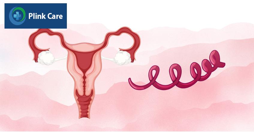 xoắn khuẩn giang mai tồn tại nhiều trong vùng sinh dục nữ