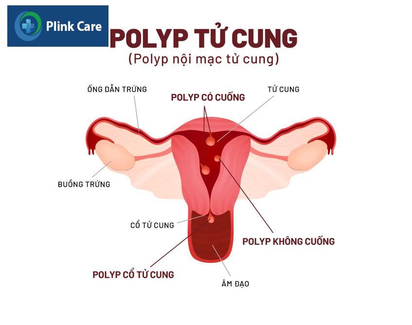 bị polyp cổ tử cung