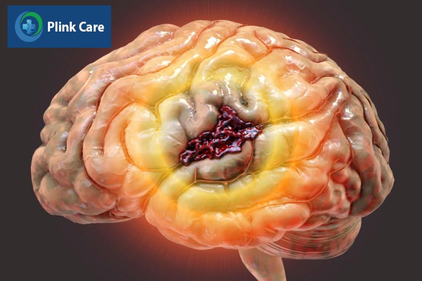 bị xuất huyết não có nguy hiểm không