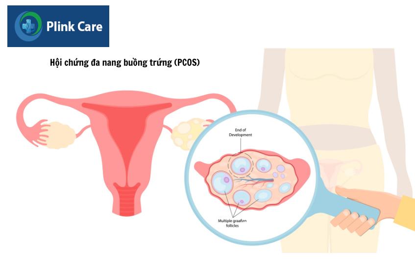 Buồng trứng đa nang có tự khỏi được không nếu điều trị tại nhà được mhiều chị em băn khoăn