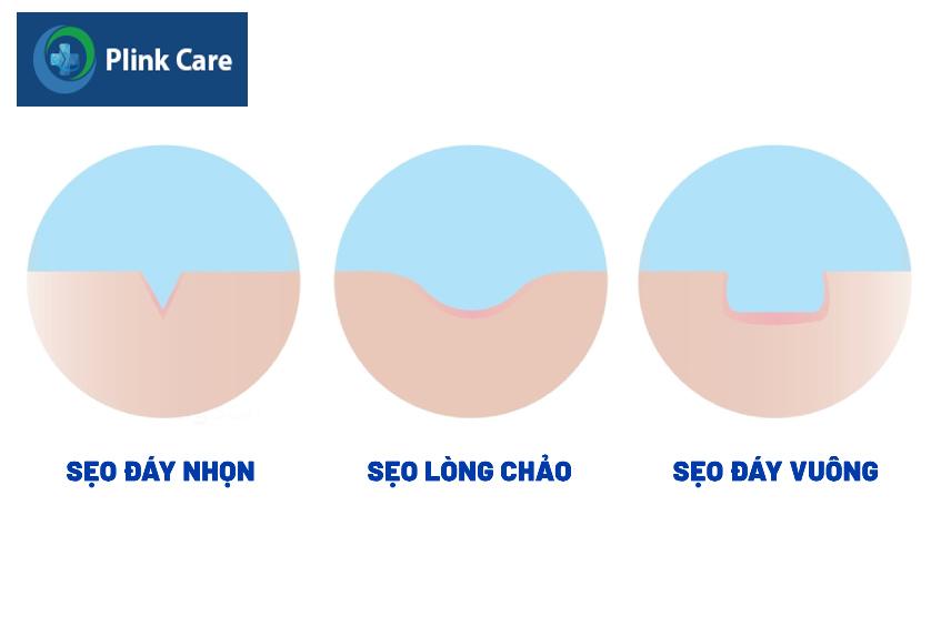 các loại sẹo thường lựa chọn chấm tca