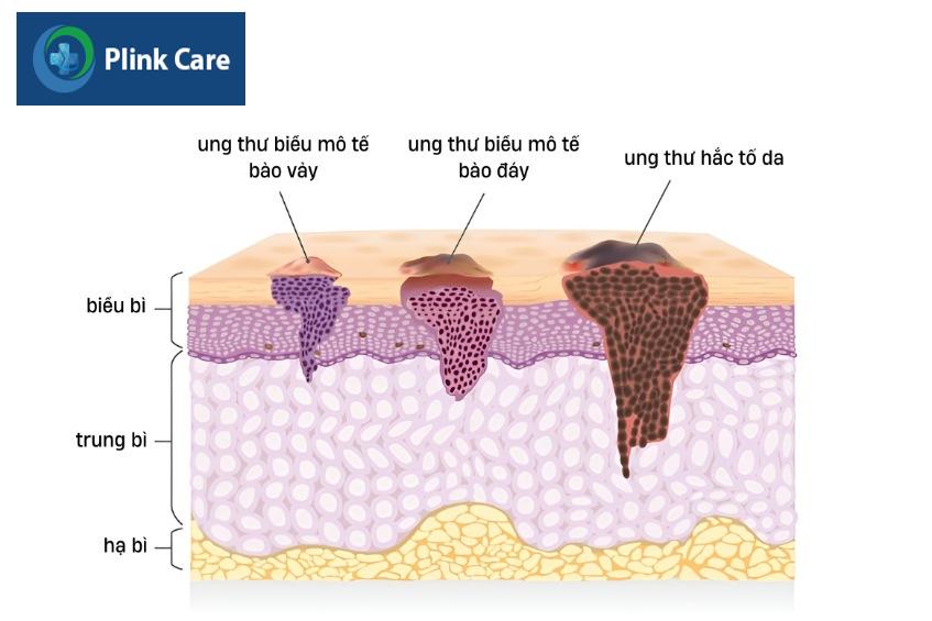 các tổn thương dưới da do ung thư