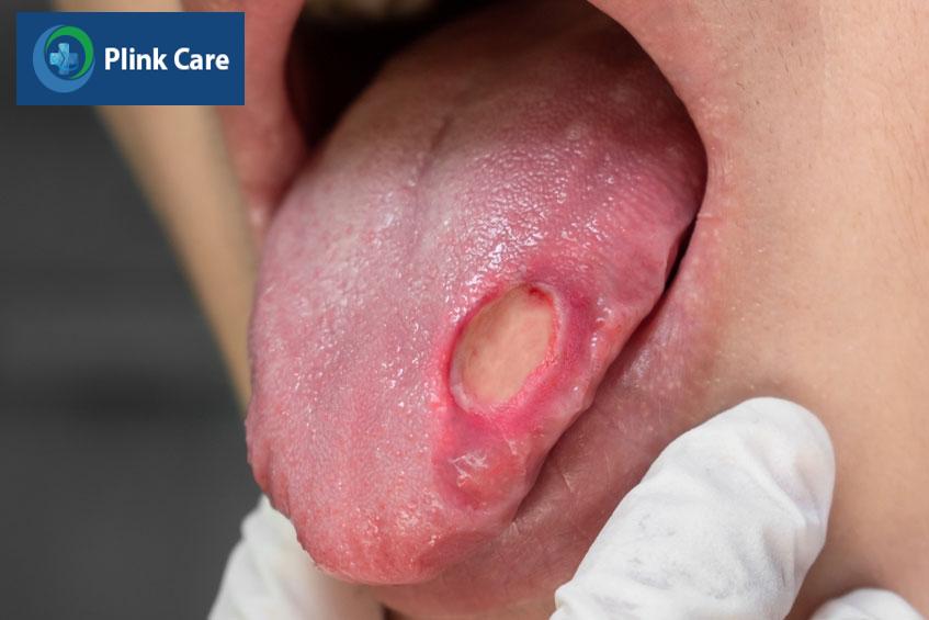 các vết loét xuất hiện ở lưỡi