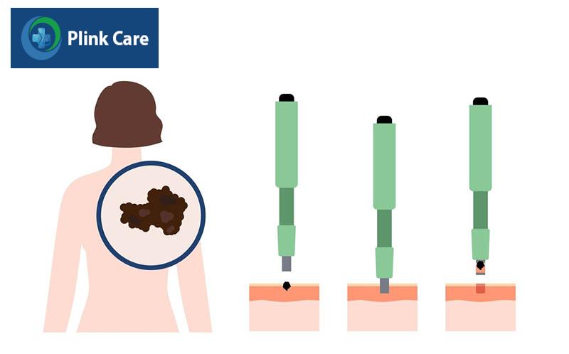 Sinh thiết đục lỗ thường để lại một vết sẹo nhỏ hoặc không để lại sẹo.