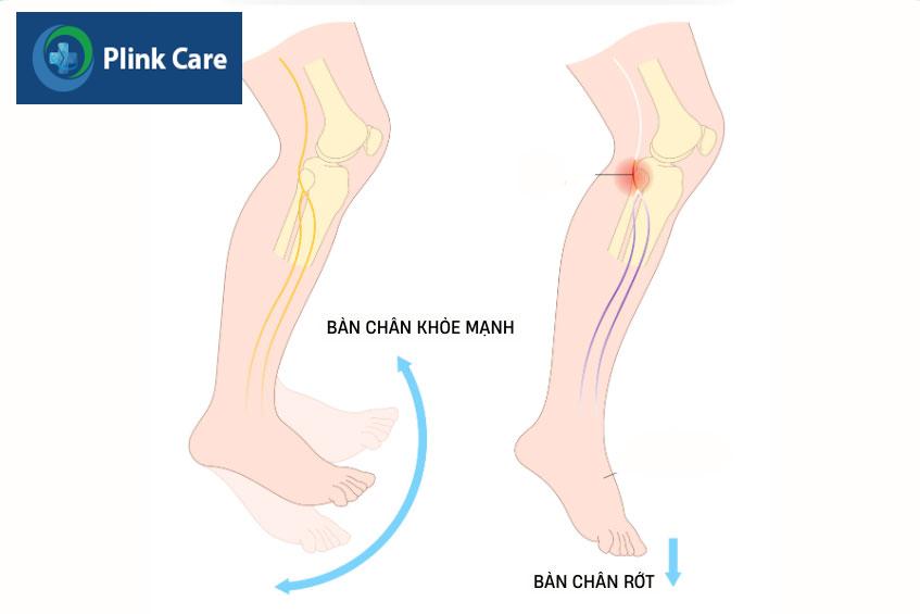 chấn thương hệ thống dây thần kinh