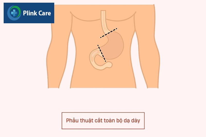 có thể sống sau khi đã cắt bỏ toàn bộ dạ dày