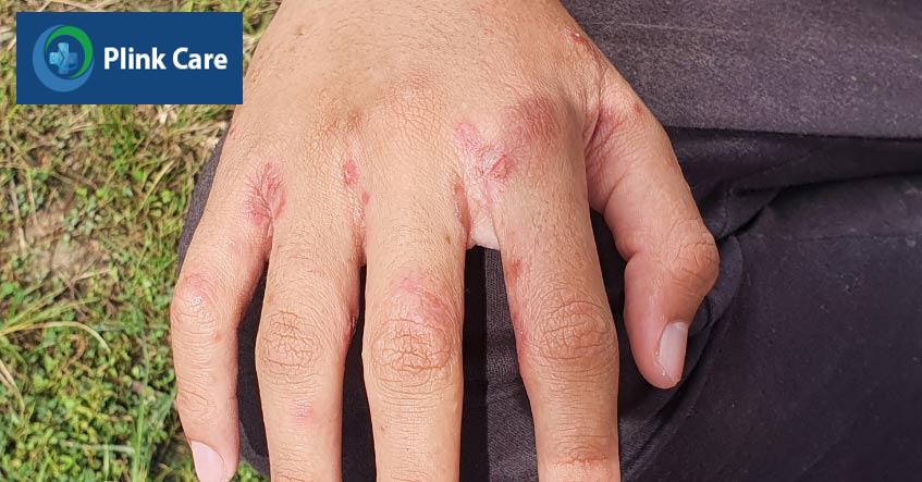 dấu hiệu của ghẻ nước