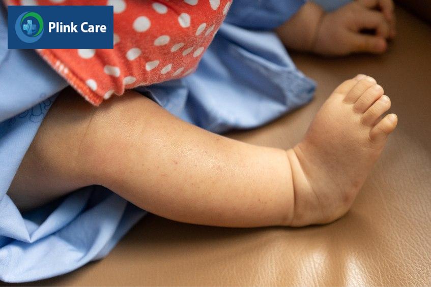 dấu hiệu giảm tiểu cầu trên da