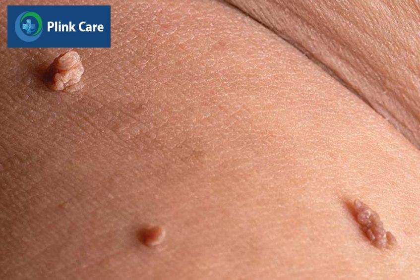 dấu hiệu nhiễm virus hpv ở nam giới với mụn cóc sinh dục